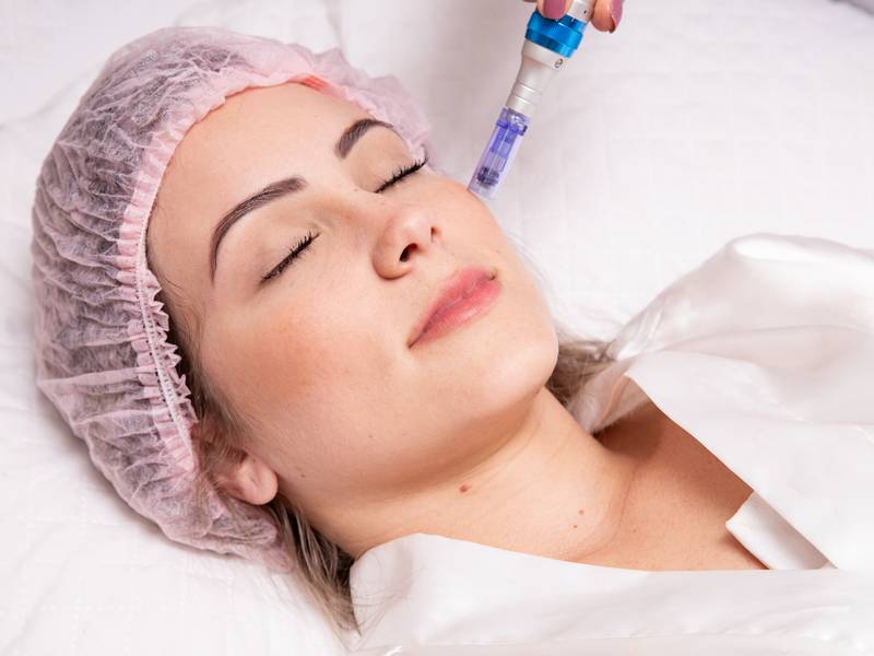 How Does Microneedling Work?