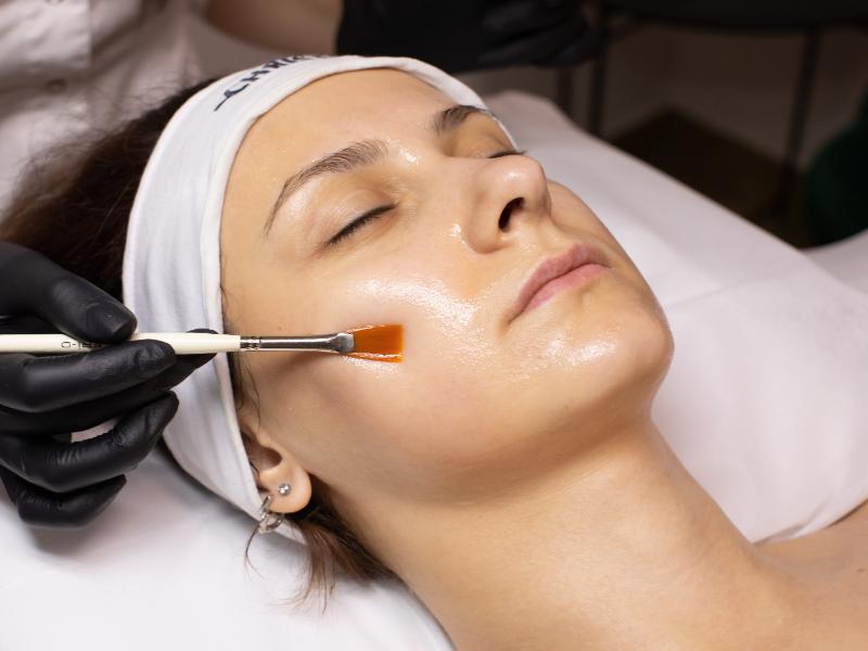 VI Peel Formula Breakdown: Choosing the Right Peel for Your Acne