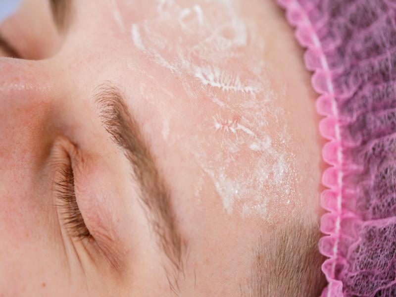Is A VI Peel Safe for All Skin Tones?