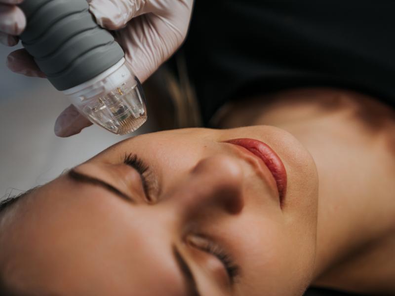Microneedling Gives Women in Dearborn, MI a Targeted and Effective Skincare Routine
